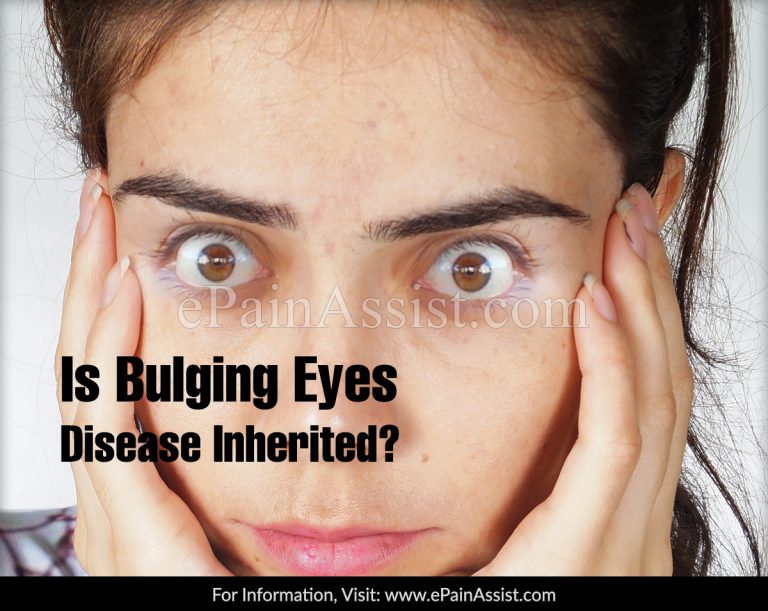 Is Bulging Eyes Disease Inherited?