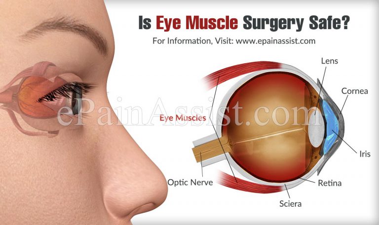 Is Eye Muscle Surgery Safe?