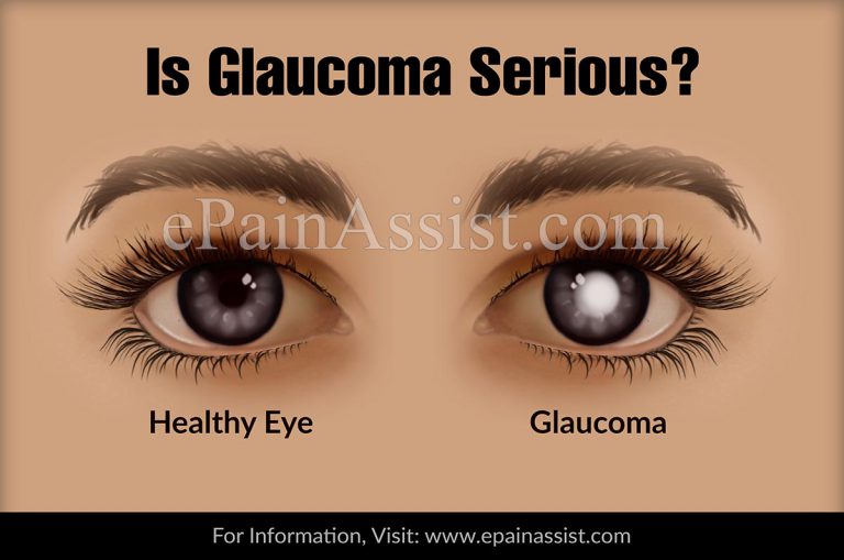Is Glaucoma Serious?