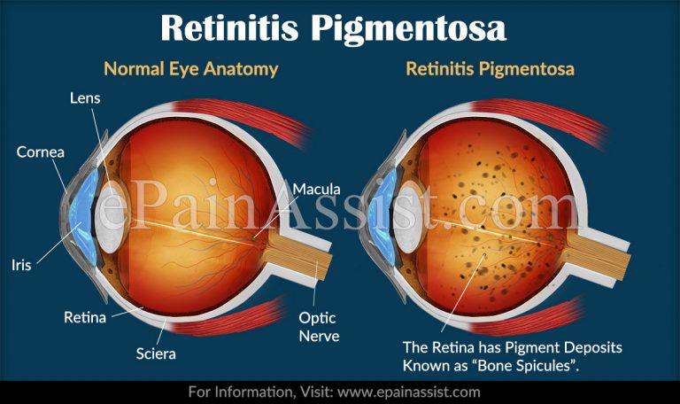 10 Rare Eye Diseases & Their Treatment