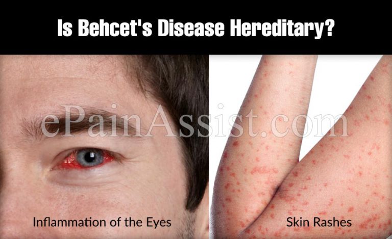 Is Behcet’s Disease Hereditary?