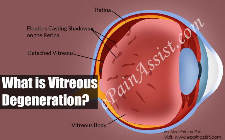 Vitreous Degeneration : Types, Causes, Symptoms, Treatment, Surgery, Recovery Period