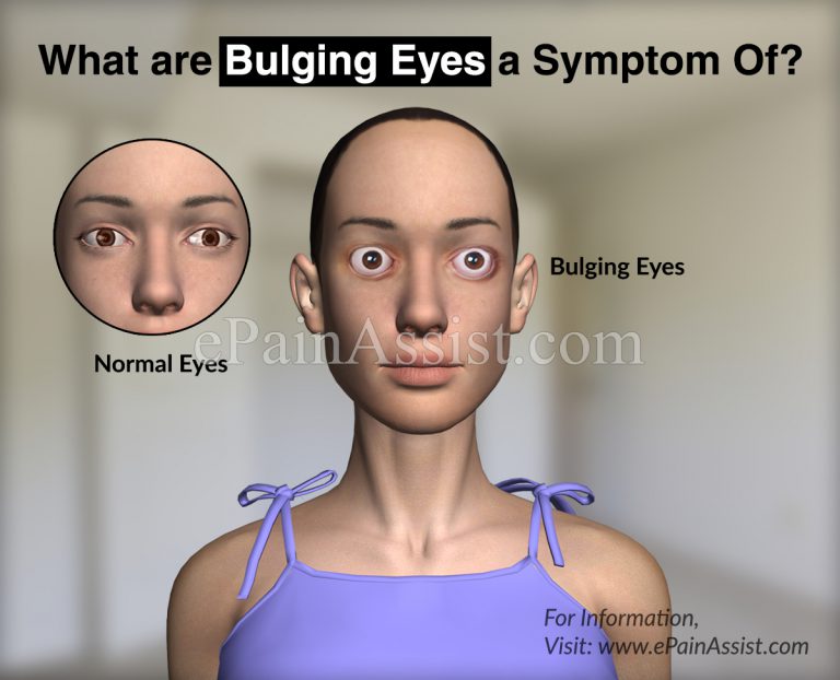 What are Bulging Eyes a Symptom Of?