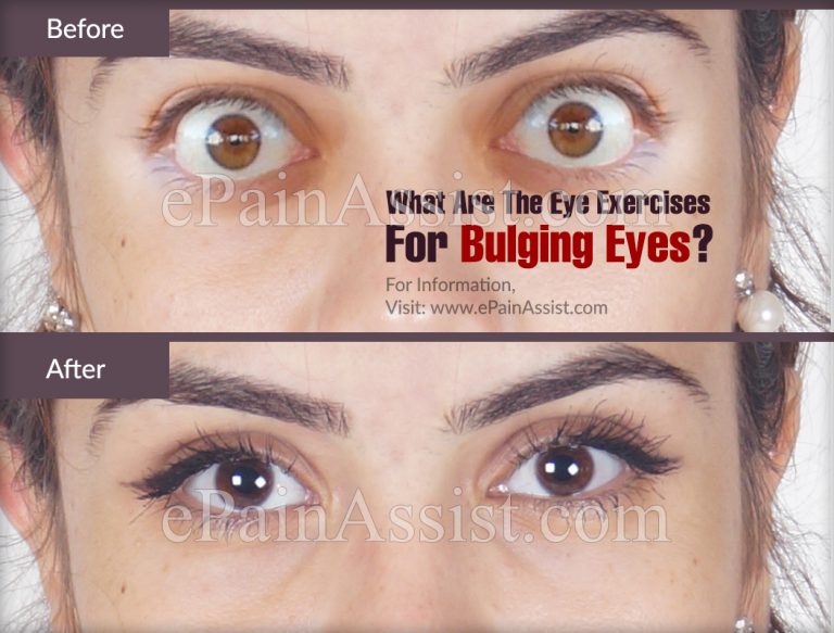 What Are The Eye Exercises For Bulging Eyes?