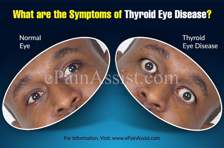 What are the Symptoms of Thyroid Eye Disease?
