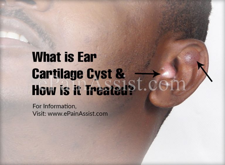 What is Ear Cartilage Cyst & How is it Treated? | Causes, Symptoms of Ear Cartilage Cyst
