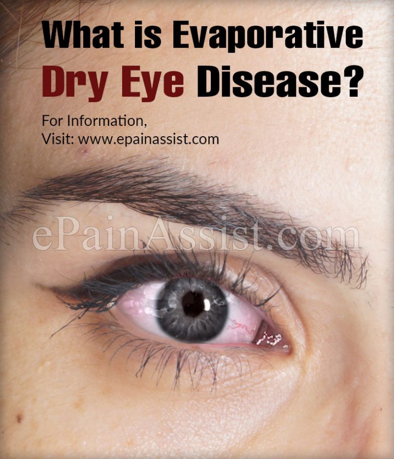 What is Evaporative Dry Eye : Treatment, Home Remedies, What Happens if EDE is not Treated?