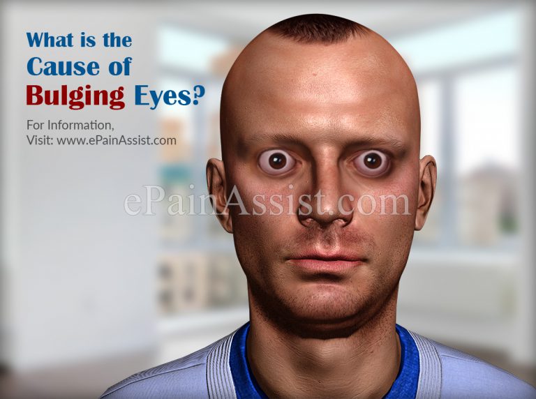 What is the Cause of Bulging Eyes?