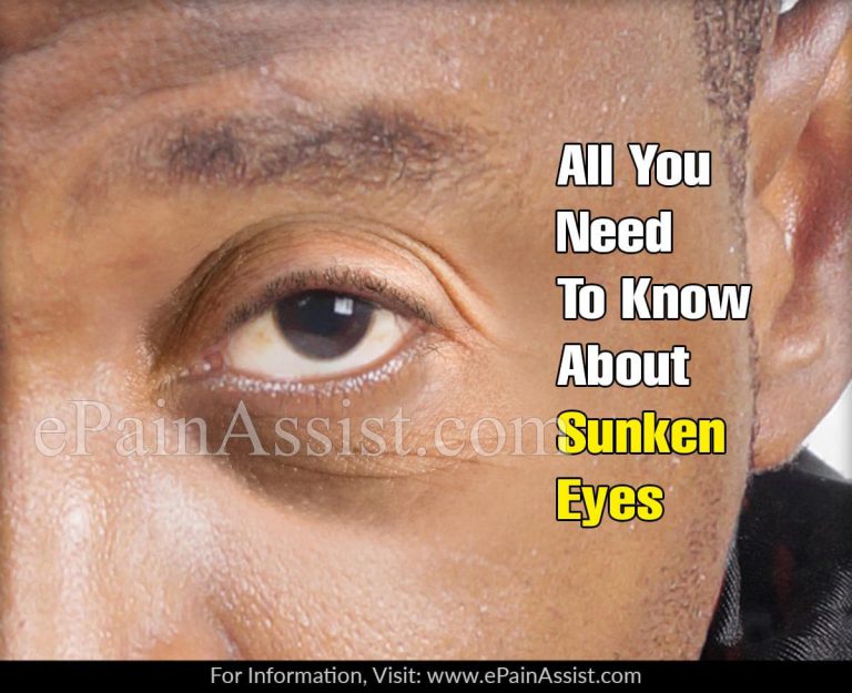 Sunken Eyes: Causes, Treatment, Home Remedies