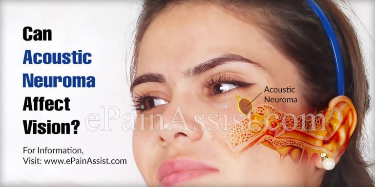 Can Acoustic Neuroma Affect Vision & Will Brain MRI Show Acoustic Neuroma?