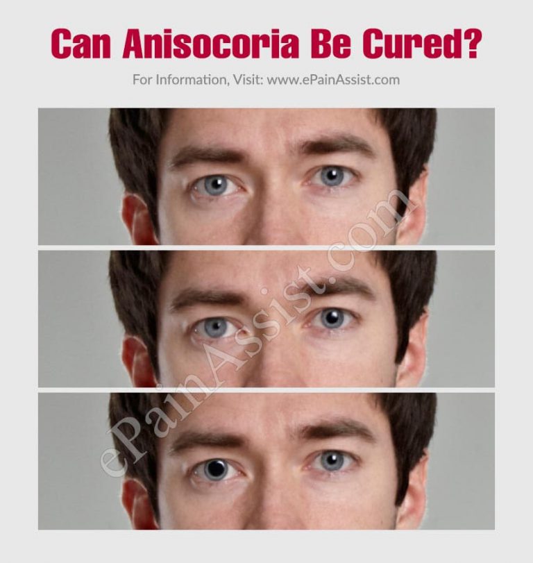 Can Anisocoria Be Cured?