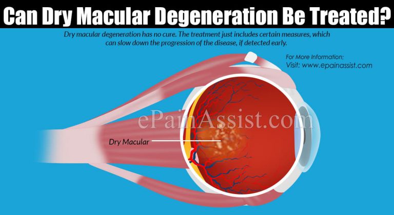 Can Dry Macular Degeneration Be Treated?