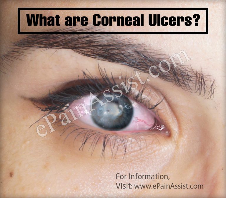 Corneal Ulcers: Causes, Symptoms, Treatment, Prognosis