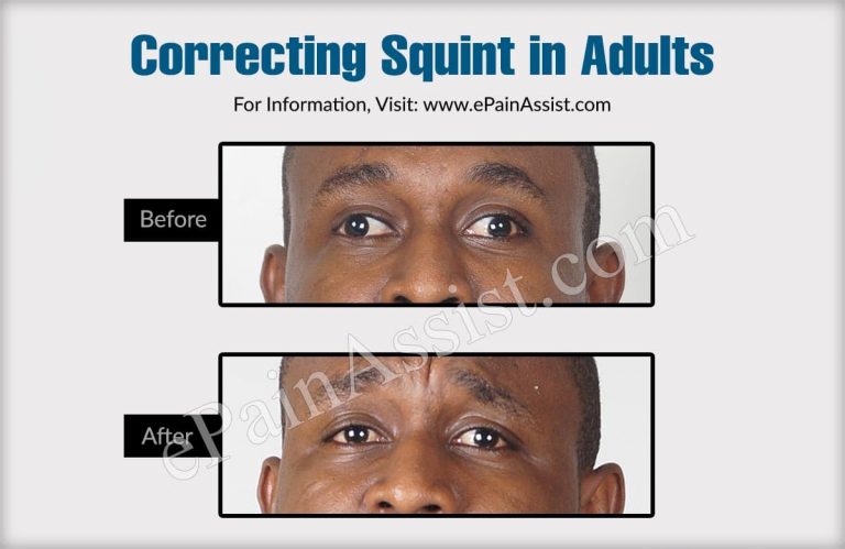 Correcting Squint in Adults
