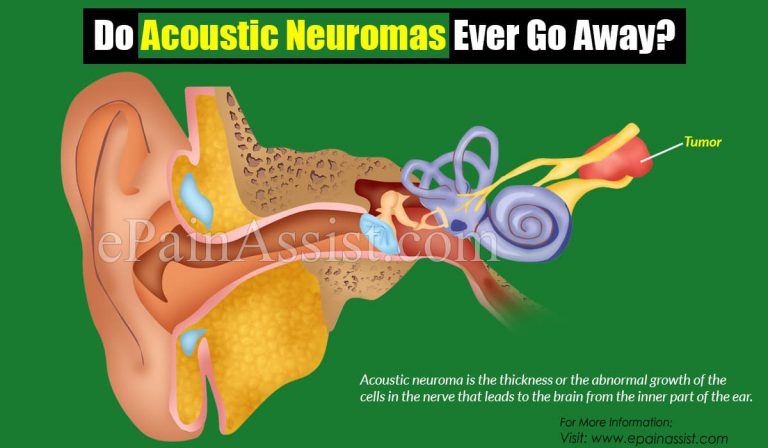 Do Acoustic Neuromas Ever Go Away?
