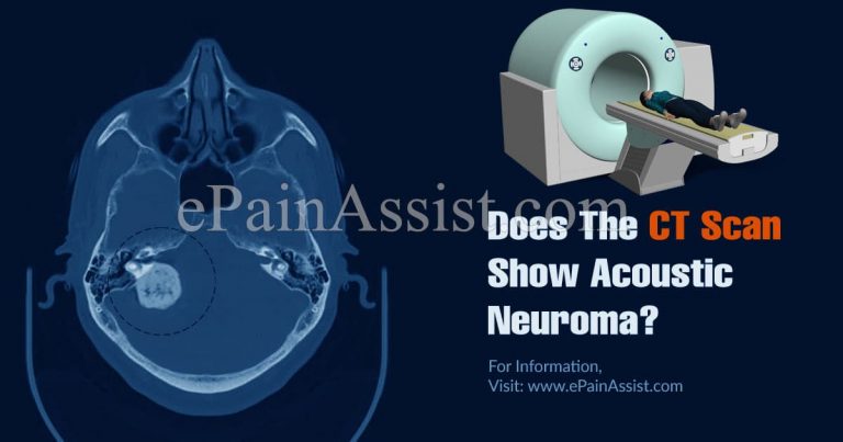 Does CT Scan Show Acoustic Neuroma & How Do They Remove An Acoustic Neuroma?