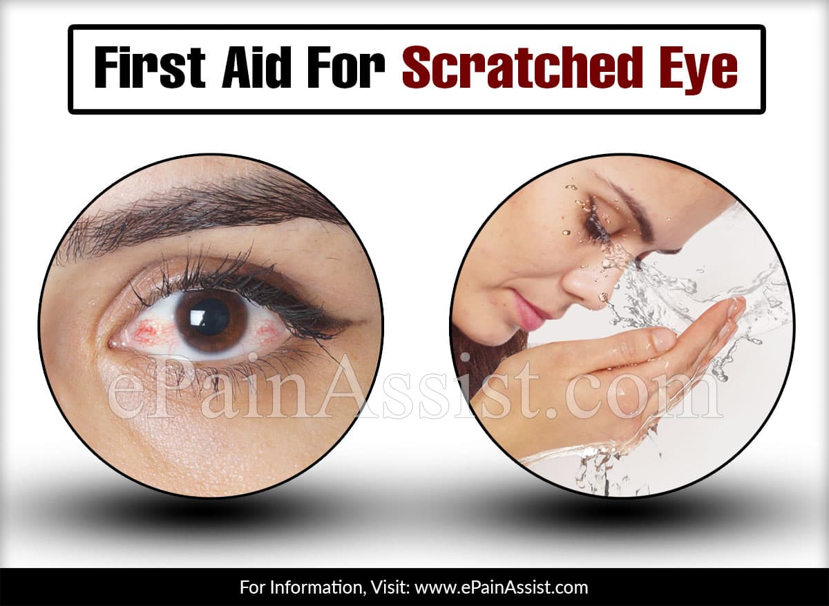 First Aid For Scratched Eye