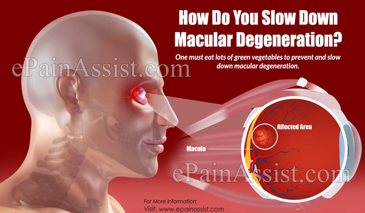 How Do You Slow Down Macular Degeneration?