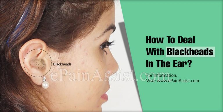 How To Deal With Blackheads In The Ear?