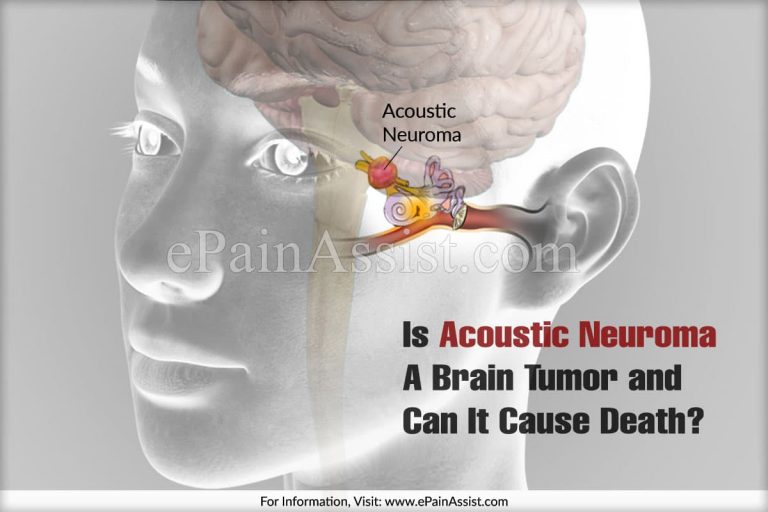 Is Acoustic Neuroma A Brain Tumor & Can It Cause Death?