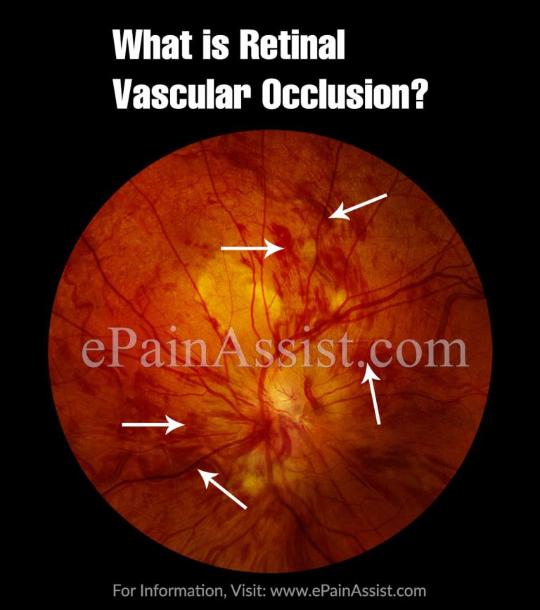 Retinal Vascular Occlusion : Types, Causes, Prevention
