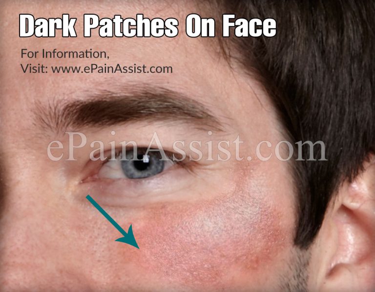 Dark Patches On Face