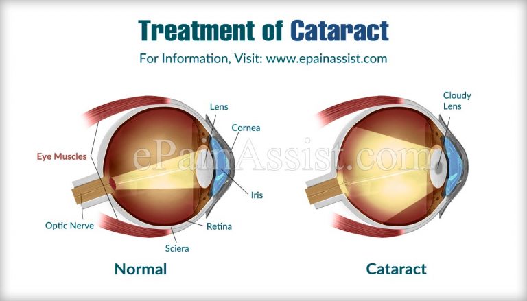 Treatment of Cataract & Nutrition to Avoid Early Cataract