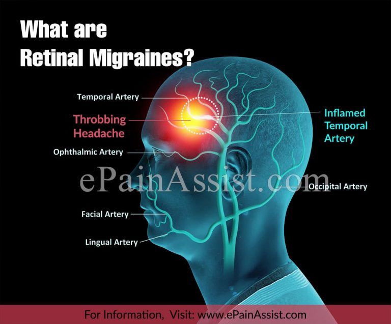 Retinal Migraines: Causes, Symptoms, Treatment, Diagnosis
