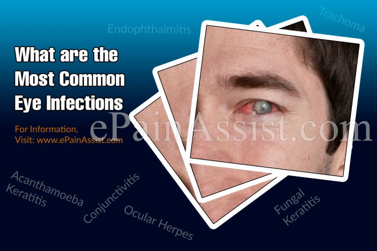 What are the Most Common Eye Infections & How to Get Rid of an Eye Infection?