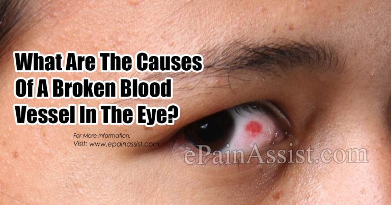 What Causes A Blood Vessel To Break In Your Eye, Its Treatment & How Long Does It Take To Heal?