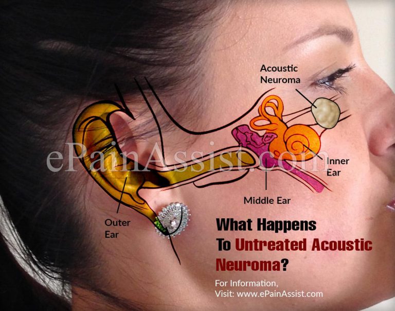 What Happens To Untreated Acoustic Neuroma & When To Go To Doctor?