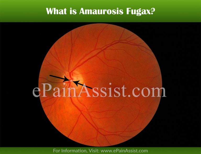 What is Amaurosis Fugax : Symptoms, Causes, Treatment