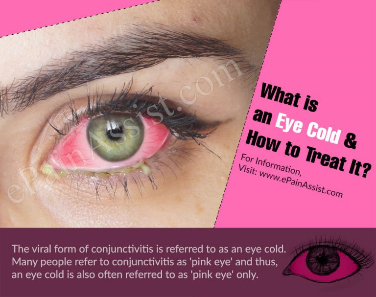 What is an Eye Cold & How to Treat It?