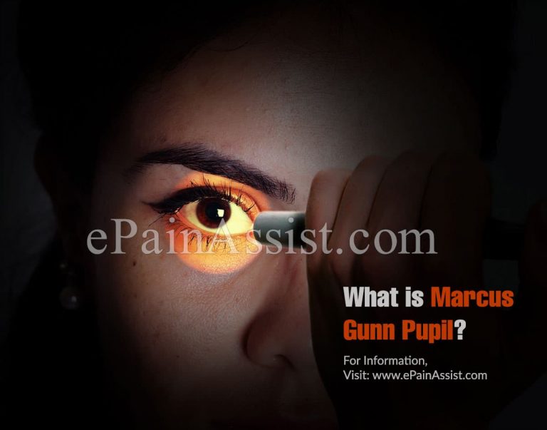 What is Marcus Gunn Pupil & How is it Treated?|Causes, Symptoms and Diagnosis of Marcus Gunn Pupil
