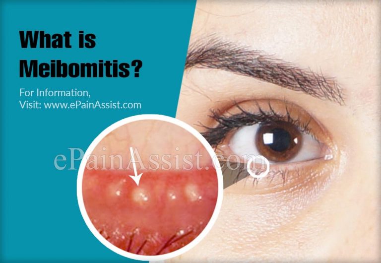 What is Meibomitis & How is it Treated? | Causes, Symptoms, Prevention of Meibomitis
