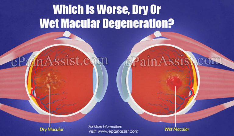 Which Is Worse, Dry Or Wet Macular Degeneration?