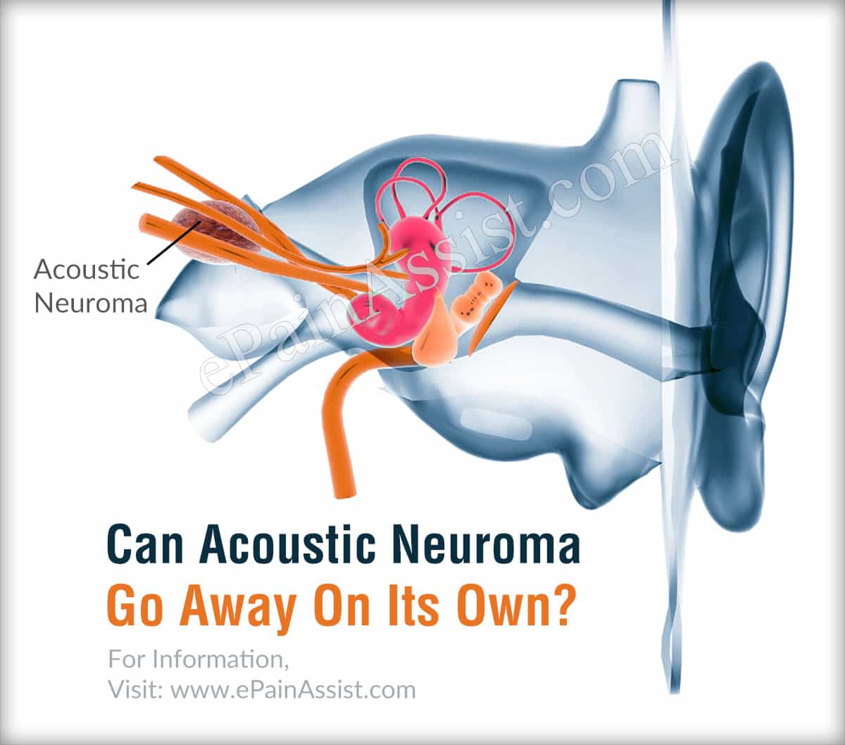 Can Acoustic Neuroma Go Away On Its Own?