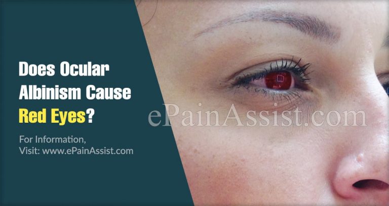 Does Ocular Albinism Cause Red Eyes & What To Do About It?