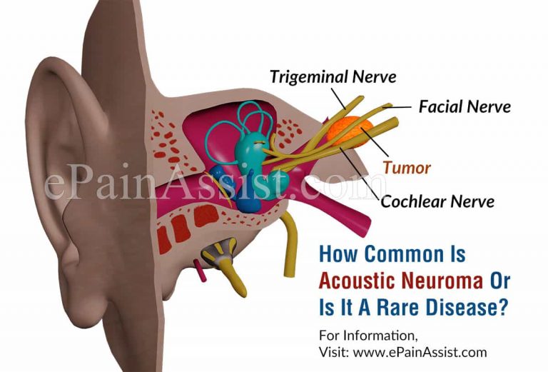 How Common Is Acoustic Neuroma Or Is It A Rare Disease?