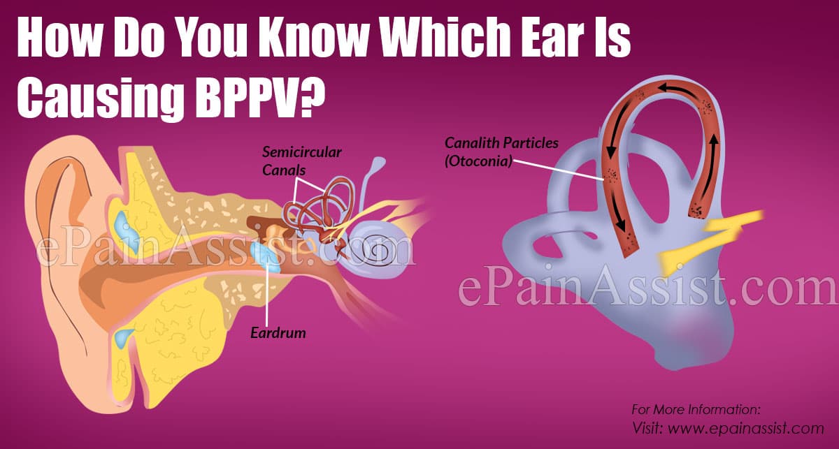 How Do You Know Which Ear Is Causing BPPV?