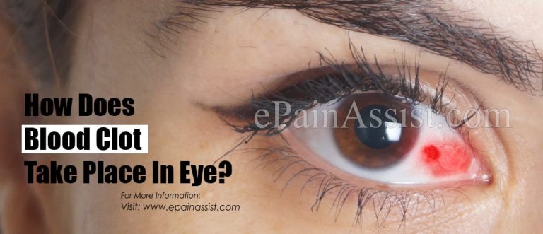 How Does Blood Clot Take Place In Eye & How To Fix It?