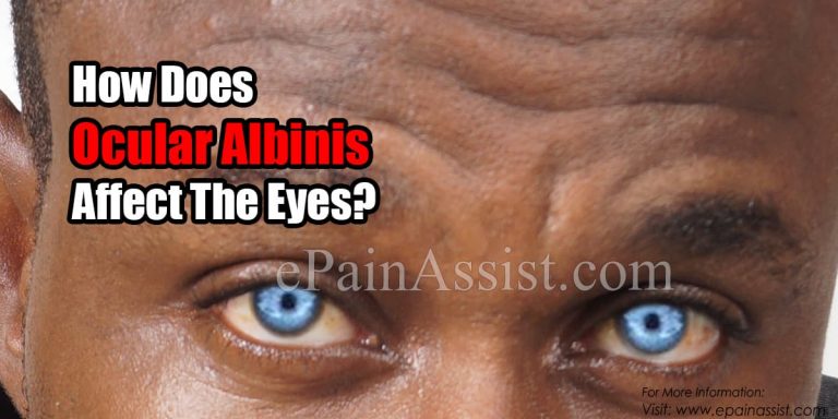 How Does Ocular Albinism Affect The Eyes & What Triggers It?