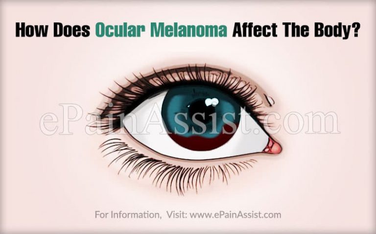How Does Ocular Melanoma Affect The Body & What Triggers It?
