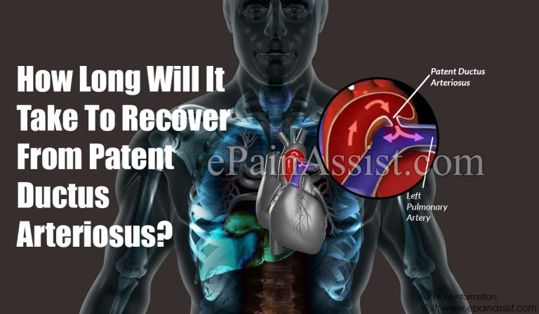 How Long Will It Take To Recover From Patent Ductus Arteriosus & How Long Do The Symptoms Last?