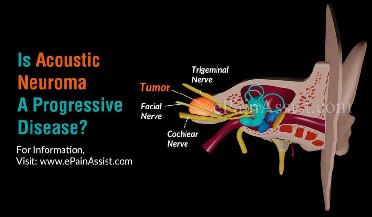 Is Acoustic Neuroma A Progressive Disease & Alternative Treatments For It