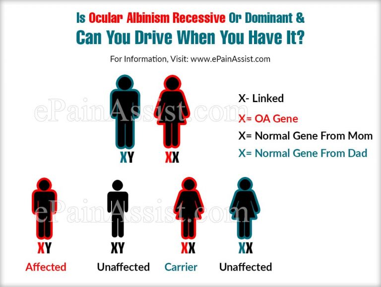 Is Ocular Albinism Recessive Or Dominant & Can You Drive When You Have It?