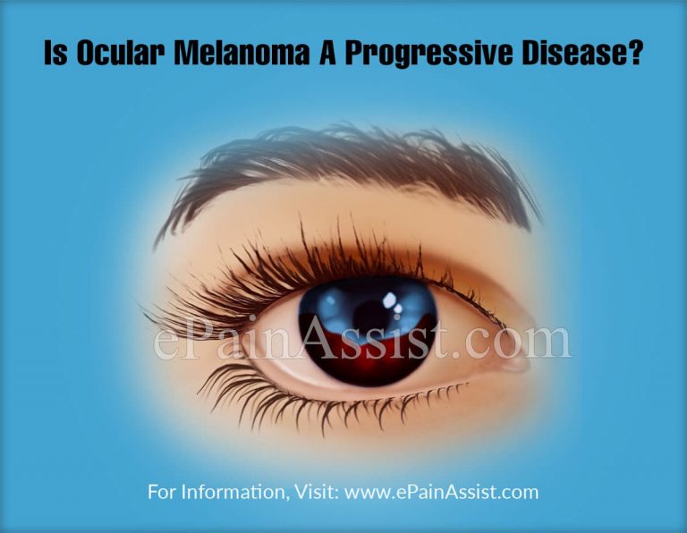 Is Ocular Melanoma A Progressive Disease & Alternative Treatments For It?