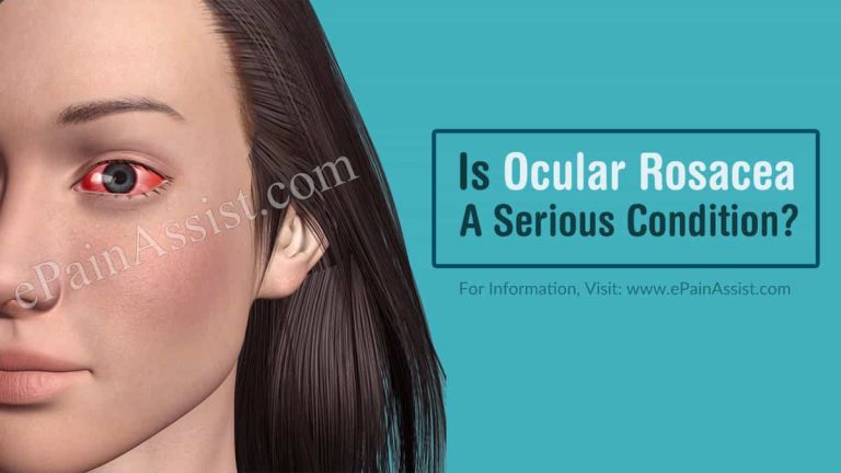 Is Ocular Rosacea A Serious Condition & Can It Be Reversed?