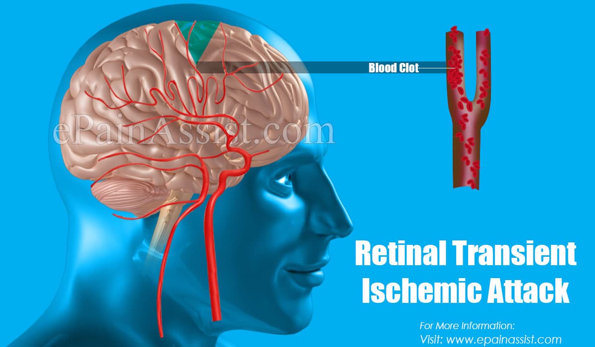 Retinal Transient Ischemic Attack