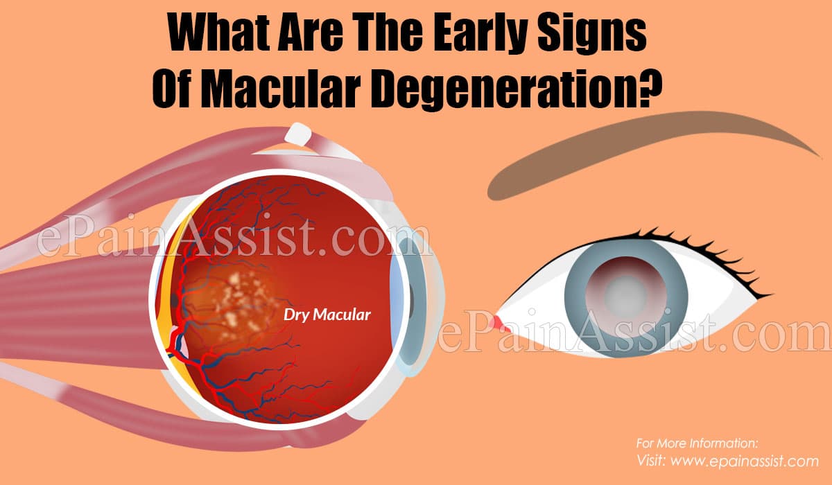 What Are The Early Signs Of Macular Degeneration?